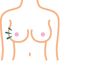 A woman with a tattoo on her left breast. Beschreibung von KI generiert